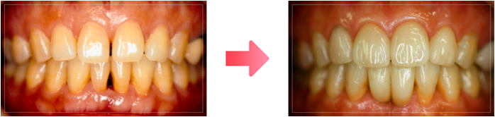 ラミネートベニア治療の症例