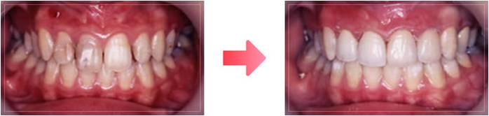 ラミネートベニア治療の症例2