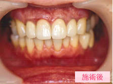 オールセラミック