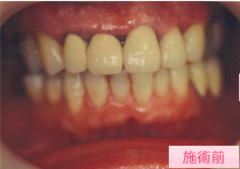 オールセラミック