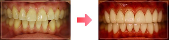 オールセラミック矯正の例
