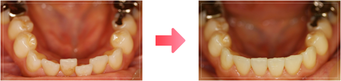 マウスピース矯正の症例