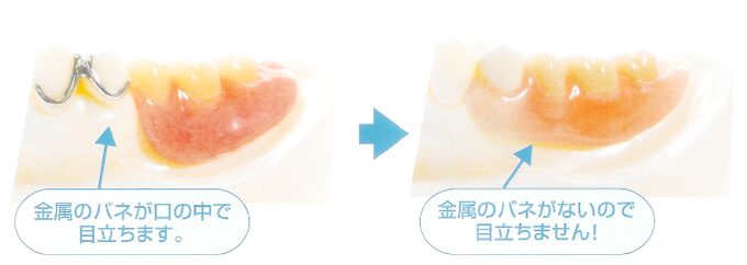 保険の入れ歯とエステティックデンチャーの比較