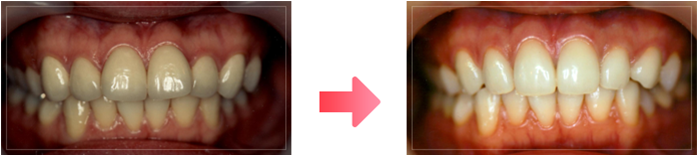 他院で治療したセラミックの形が気に入らず来院し歯の形態をかえたい。