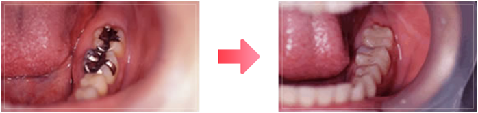 ハイブリッドインレー症例