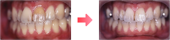 ノンバイタルホワイトニング症例