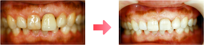 他院で入れた被せ物が自分の歯に合っていなく作り変えたい。