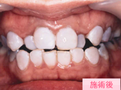 ティースマニキュア