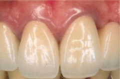 金属を使用したケース（ズーム）