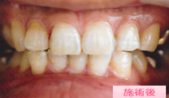 ノンバイタルホワイトニング