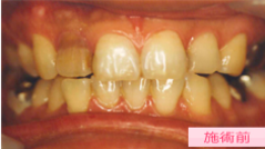 ノンバイタルホワイトニング